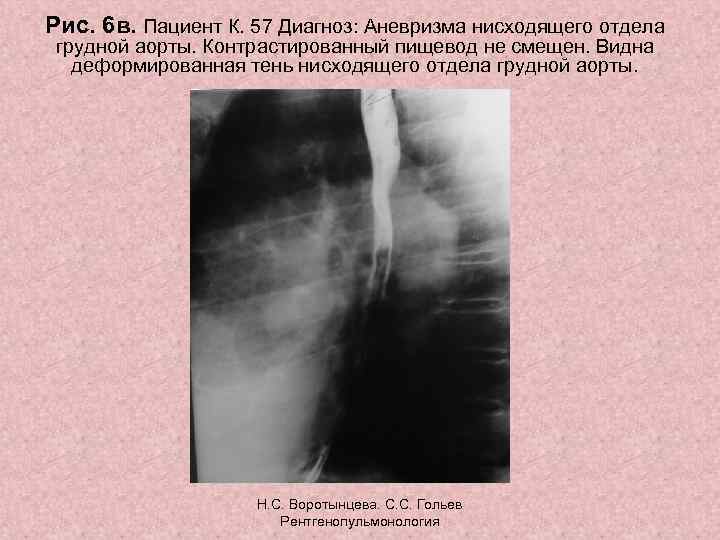 Рис. 6 в. Пациент К. 57 Диагноз: Аневризма нисходящего отдела грудной аорты. Контрастированный пищевод