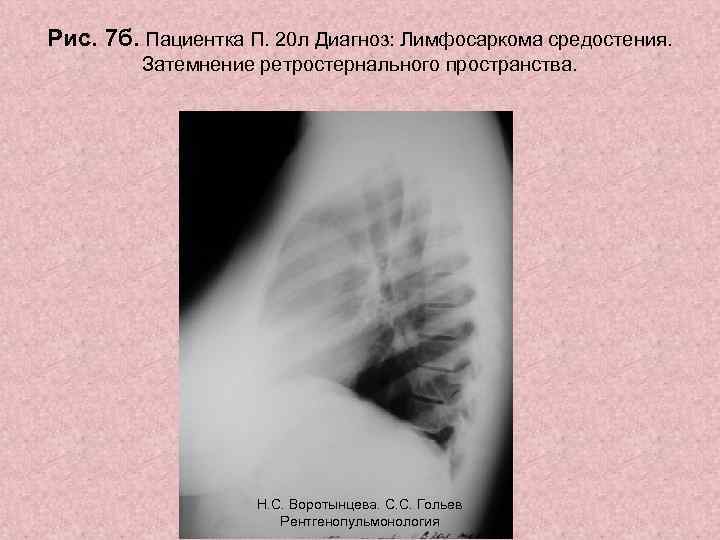 Рис. 7 б. Пациентка П. 20 л Диагноз: Лимфосаркома средостения. Затемнение ретростернального пространства. Н.