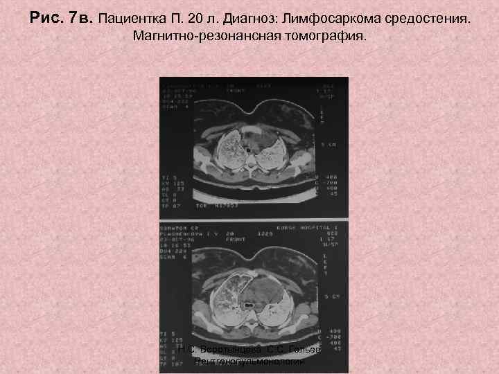 Рис. 7 в. Пациентка П. 20 л. Диагноз: Лимфосаркома средостения. Магнитно-резонансная томография. Н. С.