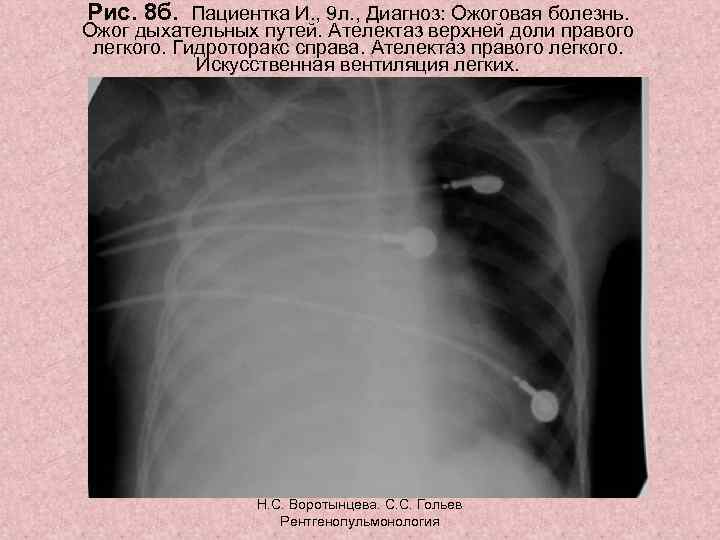 Рис. 8 б. Пациентка И. , 9 л. , Диагноз: Ожоговая болезнь. Ожог дыхательных