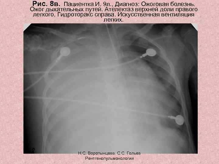 Рис. 8 в. Пациентка И. 9 л. , Диагноз: Ожоговая болезнь. Ожог дыхательных путей.