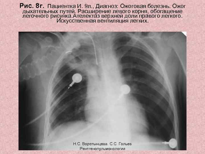 Рис. 8 г. Пациентка И. 9 л. , Диагноз: Ожоговая болезнь. Ожог дыхательных путей.