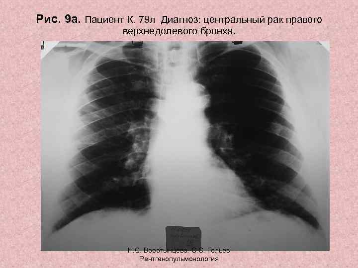 Рис. 9 а. Пациент К. 79 л Диагноз: центральный рак правого верхнедолевого бронха. Н.