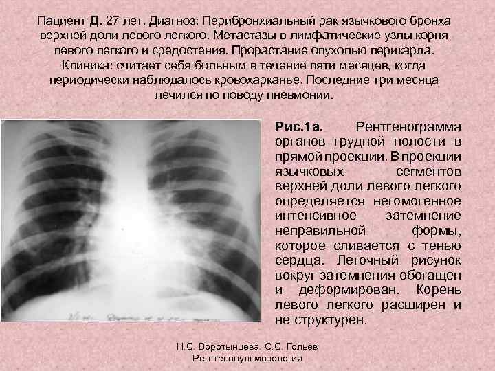 Пациент Д. 27 лет. Диагноз: Перибронхиальный рак язычкового бронха верхней доли левого легкого. Метастазы