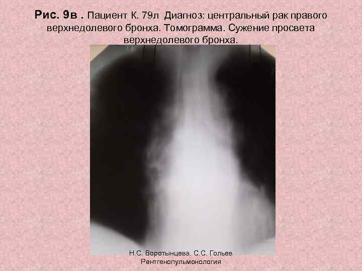 Рис. 9 в. Пациент К. 79 л Диагноз: центральный рак правого верхнедолевого бронха. Томограмма.
