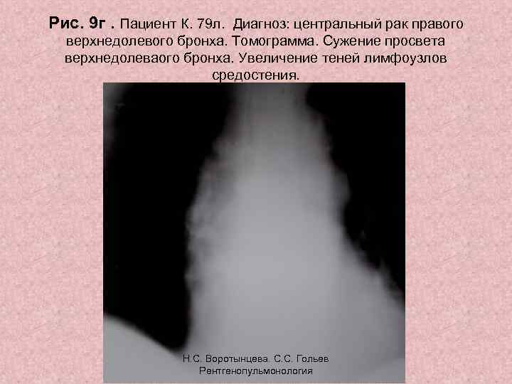 Рис. 9 г. Пациент К. 79 л. Диагноз: центральный рак правого верхнедолевого бронха. Томограмма.