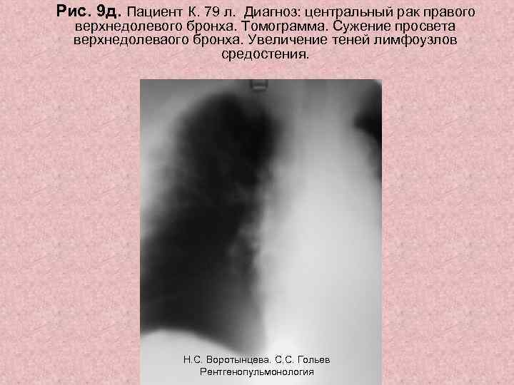 Рис. 9 д. Пациент К. 79 л. Диагноз: центральный рак правого верхнедолевого бронха. Томограмма.