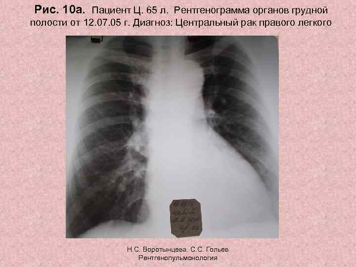 Рис. 10 а. Пациент Ц. 65 л. Рентгенограмма органов грудной полости от 12. 07.