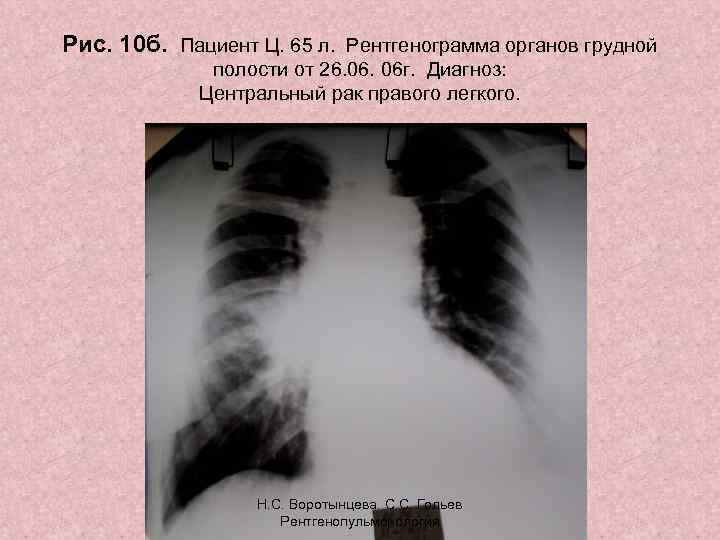 Рис. 10 б. Пациент Ц. 65 л. Рентгенограмма органов грудной полости от 26. 06