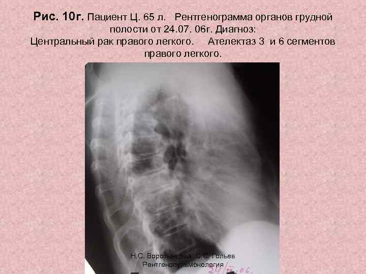 Рис. 10 г. Пациент Ц. 65 л. Рентгенограмма органов грудной полости от 24. 07.
