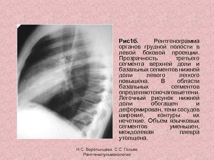  • Рис1 б. Рентгенограмма органов грудной полости в левой боковой проекции. Прозрачность третьего