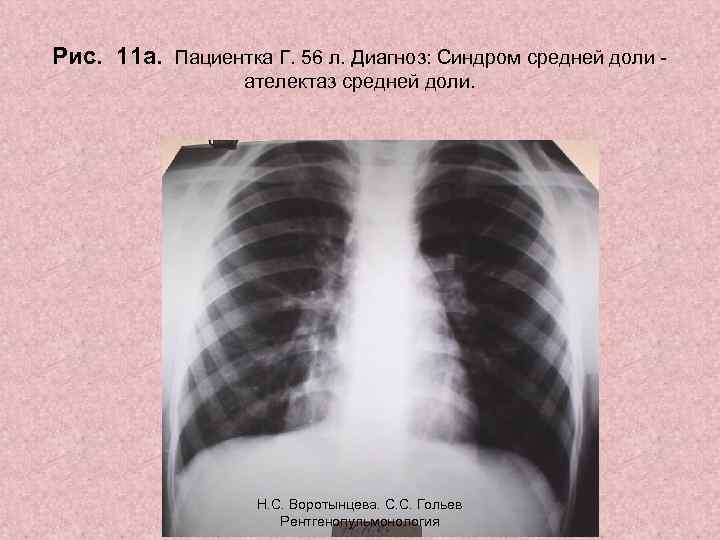 Рис. 11 а. Пациентка Г. 56 л. Диагноз: Синдром средней доли ателектаз средней доли.
