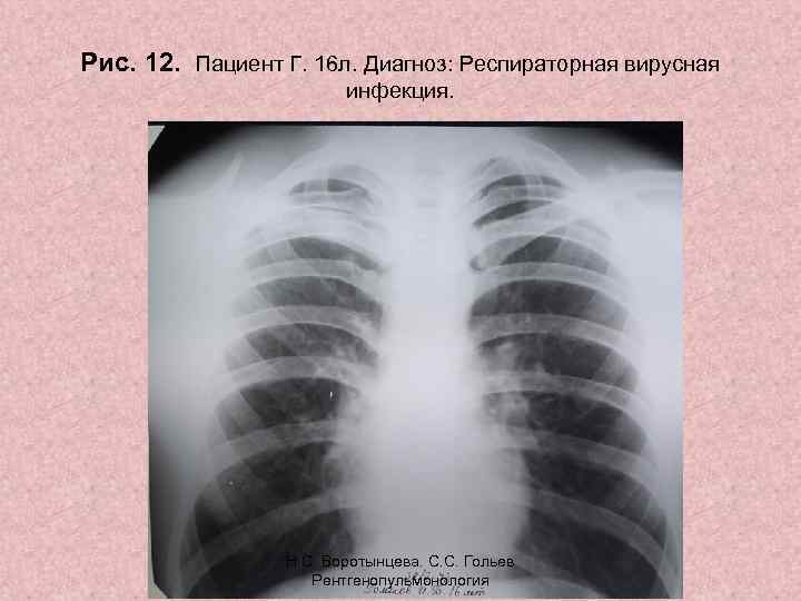 Рис. 12. Пациент Г. 16 л. Диагноз: Респираторная вирусная инфекция. Н. С. Воротынцева. С.