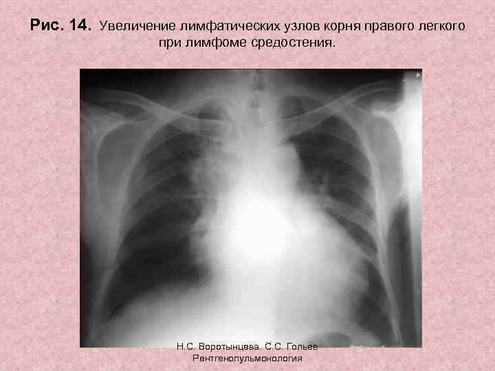 Рис. 14. Увеличение лимфатических узлов корня правого легкого при лимфоме средостения. Н. С. Воротынцева.