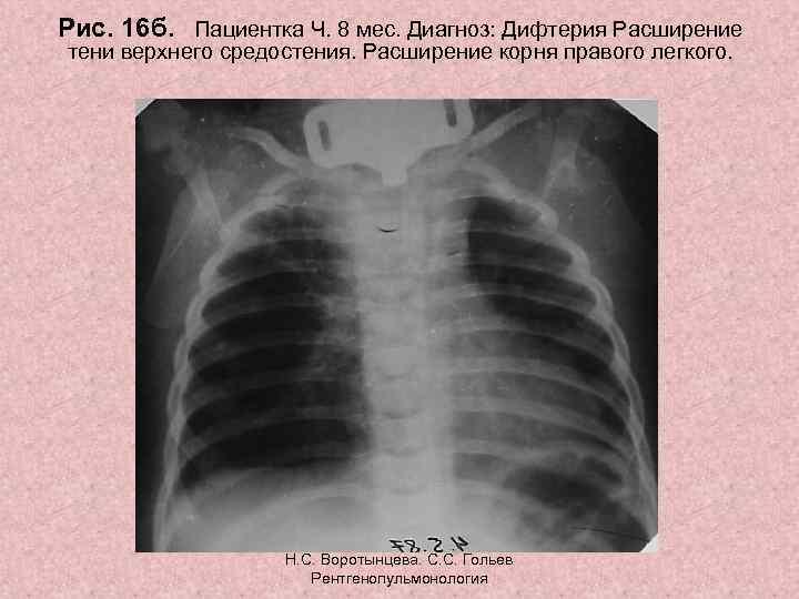 Рис. 16 б. Пациентка Ч. 8 мес. Диагноз: Дифтерия Расширение тени верхнего средостения. Расширение