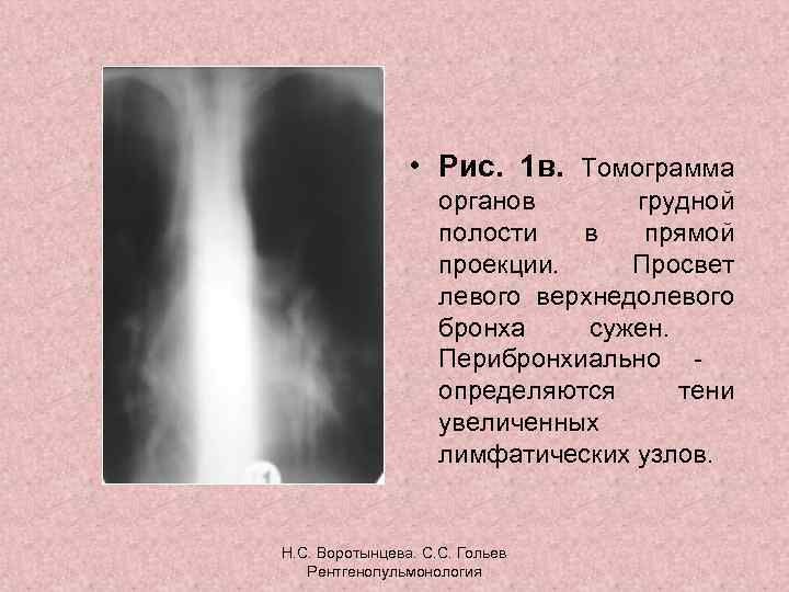  • Рис. 1 в. Томограмма органов грудной полости в прямой проекции. Просвет левого