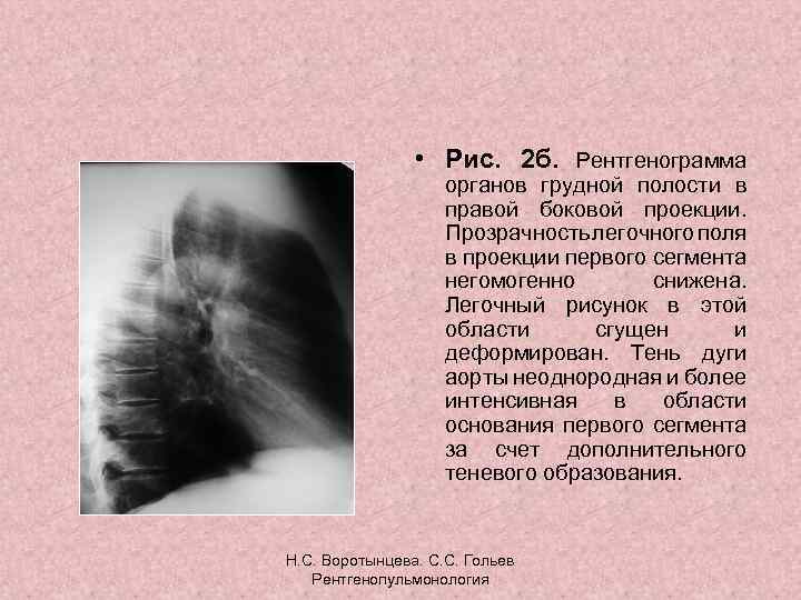  • Рис. 2 б. Рентгенограмма органов грудной полости в правой боковой проекции. Прозрачность
