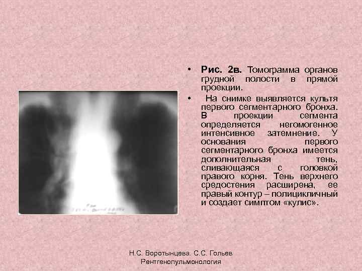  • Рис. 2 в. Томограмма органов • грудной полости в прямой проекции. На