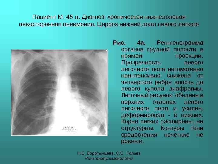 Пациент М. 45 л. Диагноз: хроническая нижнедолевая левосторонняя пневмония. Цирроз нижней доли левого легкого