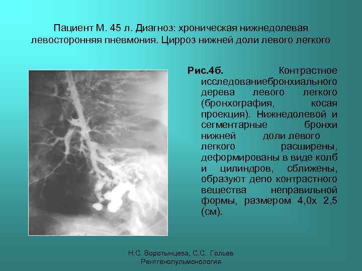 Пациент М. 45 л. Диагноз: хроническая нижнедолевая левосторонняя пневмония. Цирроз нижней доли левого легкого