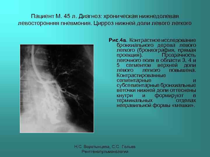 Пациент М. 45 л. Диагноз: хроническая нижнедолевая левосторонняя пневмония. Цирроз нижней доли левого легкого