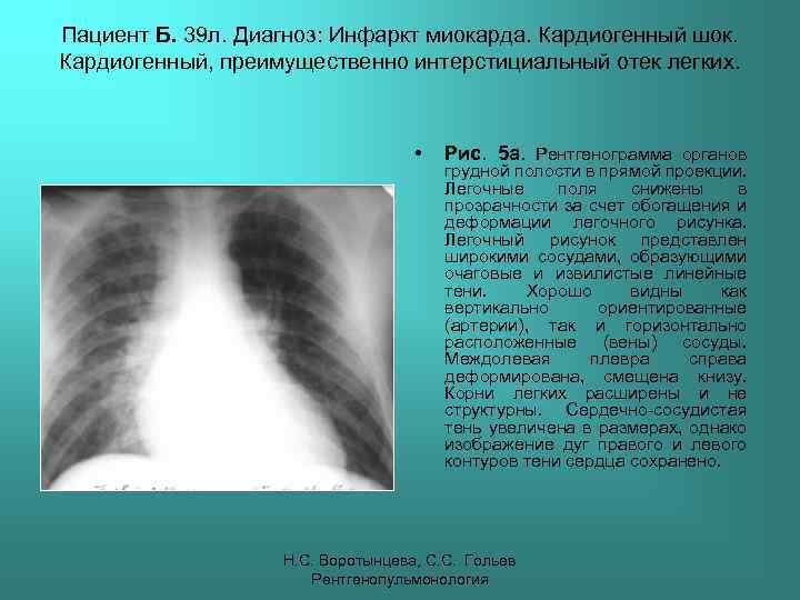 Пациент Б. 39 л. Диагноз: Инфаркт миокарда. Кардиогенный шок. Кардиогенный, преимущественно интерстициальный отек легких.