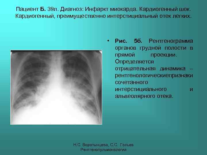 Пациент Б. 39 л. Диагноз: Инфаркт миокарда. Кардиогенный шок. Кардиогенный, преимущественно интерстициальный отек легких.