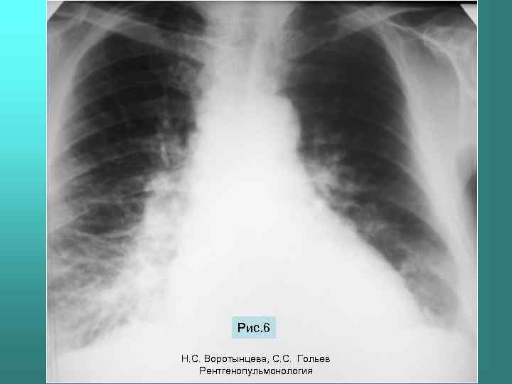 Рис. 6 Н. С. Воротынцева, С. С. Гольев Рентгенопульмонология 