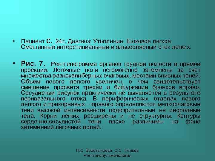  • Пациент С. 24 г. Диагноз: Утопление. Шоковое легкое. Смешанный интерстициальный и альвеолярный