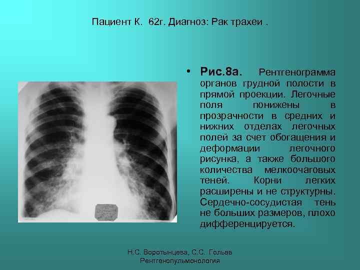 Пациент К. 62 г. Диагноз: Рак трахеи. • Рис. 8 а. Рентгенограмма органов грудной