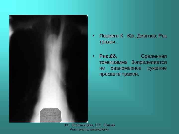  • Пациент К. 62 г. Диагноз: Рак трахеи. • Рис. 8 б. Срединная