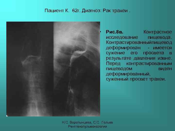 Пациент К. 62 г. Диагноз: Рак трахеи. • Рис. 8 в. Контрастное исследование пищевода.