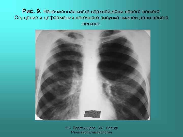 Рис. 9. Напряженная киста верхней доли левого легкого. Сгущение и деформация легочного рисунка нижней