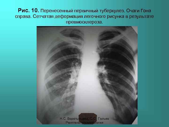 Рис. 10. Перенесенный первичный туберкулез. Очаги Гона справа. Сетчатая деформация легочного рисунка в результате