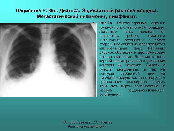 Пациентка Р. 39 л. Диагноз: Эндофитный рак тела желудка. Метастатический пневмонит, лимфангит. • Рис.