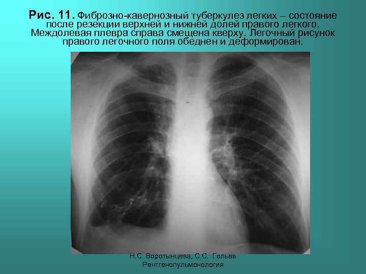 Рис. 11. Фиброзно-кавернозный туберкулез легких – состояние после резекции верхней и нижней долей правого