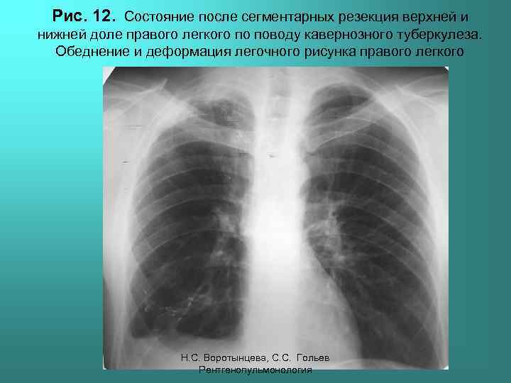 Рис. 12. Состояние после сегментарных резекция верхней и нижней доле правого легкого по поводу