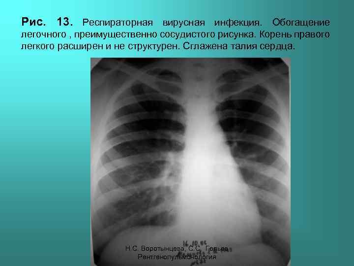 Рис. 13. Респираторная вирусная инфекция. Обогащение легочного , преимущественно сосудистого рисунка. Корень правого легкого