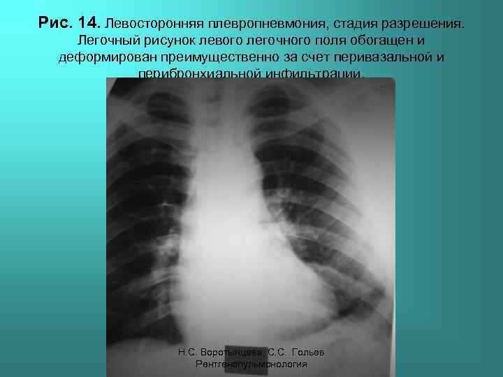 Рис. 14. Левосторонняя плевропневмония, стадия разрешения. Легочный рисунок левого легочного поля обогащен и деформирован