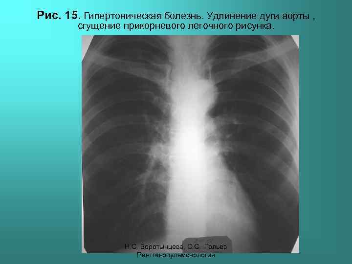 Рис. 15. Гипертоническая болезнь. Удлинение дуги аорты , сгущение прикорневого легочного рисунка. Н. С.