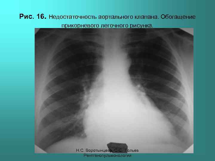 Рис. 16. Недостаточность аортального клапана. Обогащение прикорневого легочного рисунка. Н. С. Воротынцева, С. С.