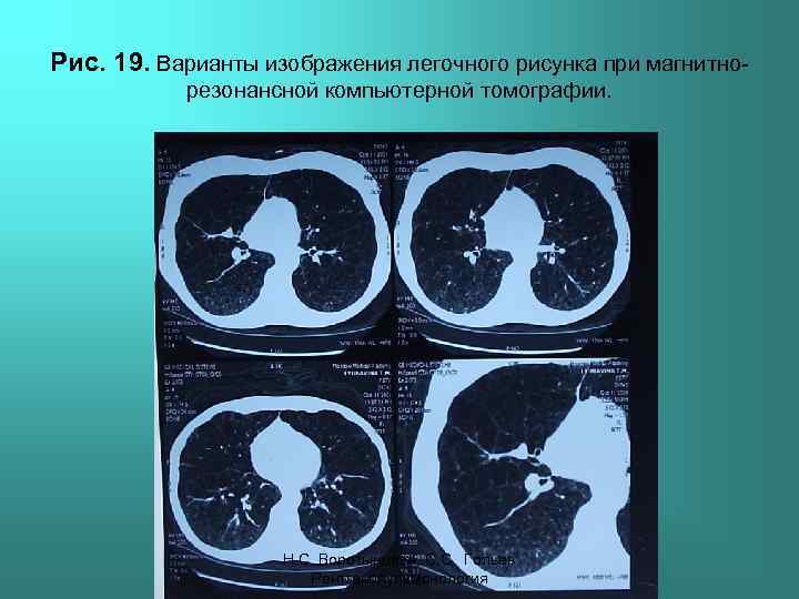 Рис. 19. Варианты изображения легочного рисунка при магнитнорезонансной компьютерной томографии. Н. С. Воротынцева, С.