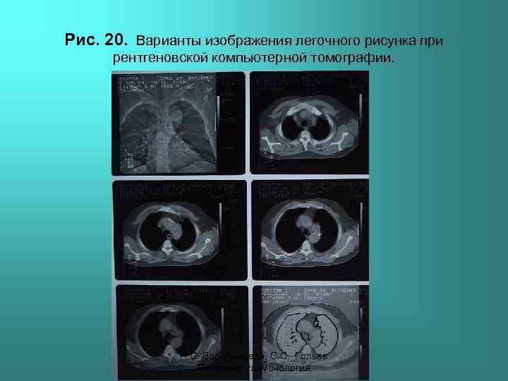 Рис. 20. Варианты изображения легочного рисунка при рентгеновской компьютерной томографии. Н. С. Воротынцева, С.