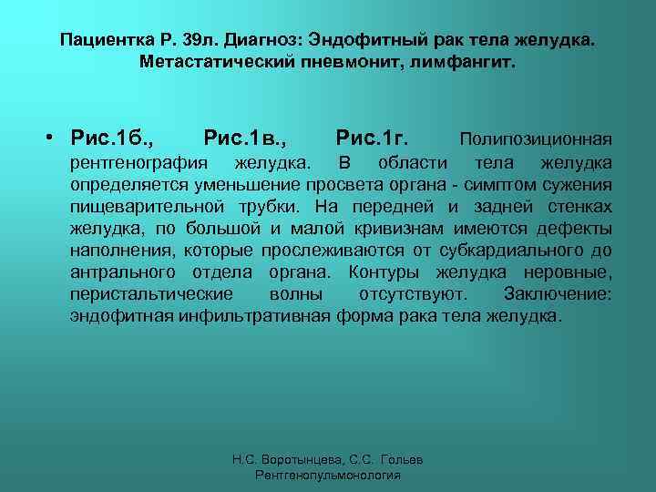 Пациентка Р. 39 л. Диагноз: Эндофитный рак тела желудка. Метастатический пневмонит, лимфангит. • Рис.