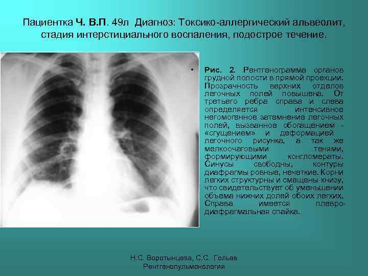 Пациентка Ч. В. П. 49 л Диагноз: Токсико-аллергический альвеолит, стадия интерстициального воспаления, подострое течение.