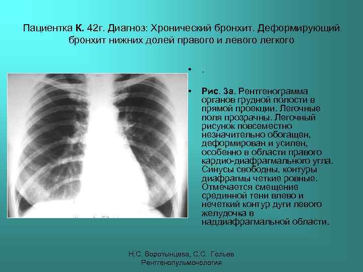 Пациентка К. 42 г. Диагноз: Хронический бронхит. Деформирующий бронхит нижних долей правого и левого