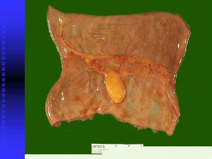 Of course, neoplasms can be benign as well as malignant, though it is not