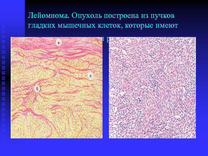 Лейомиома. Опухоль построена из пучков гладких мышечных клеток, которые имеют различную толщину и расположены