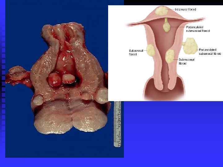 Benign neoplasms can be multiple, as is shown in this uterus with leiomyomas of