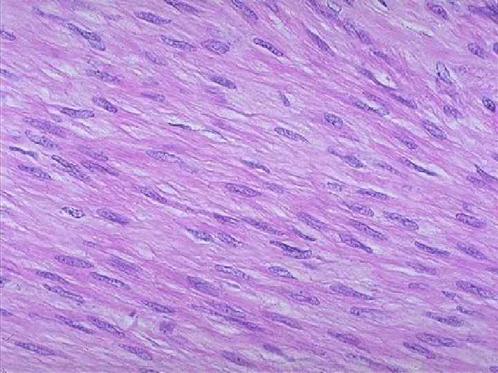 The microscopic appearance of a leiomyoma indicates that the cells do not vary greatly